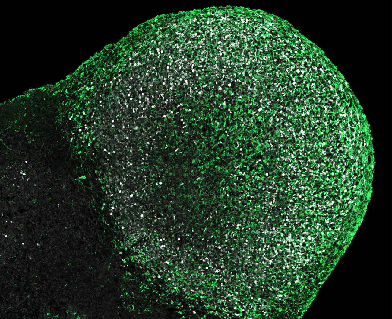 Los organoides cerebrales desvelan nuevas causas de la esclerosis tuberosa