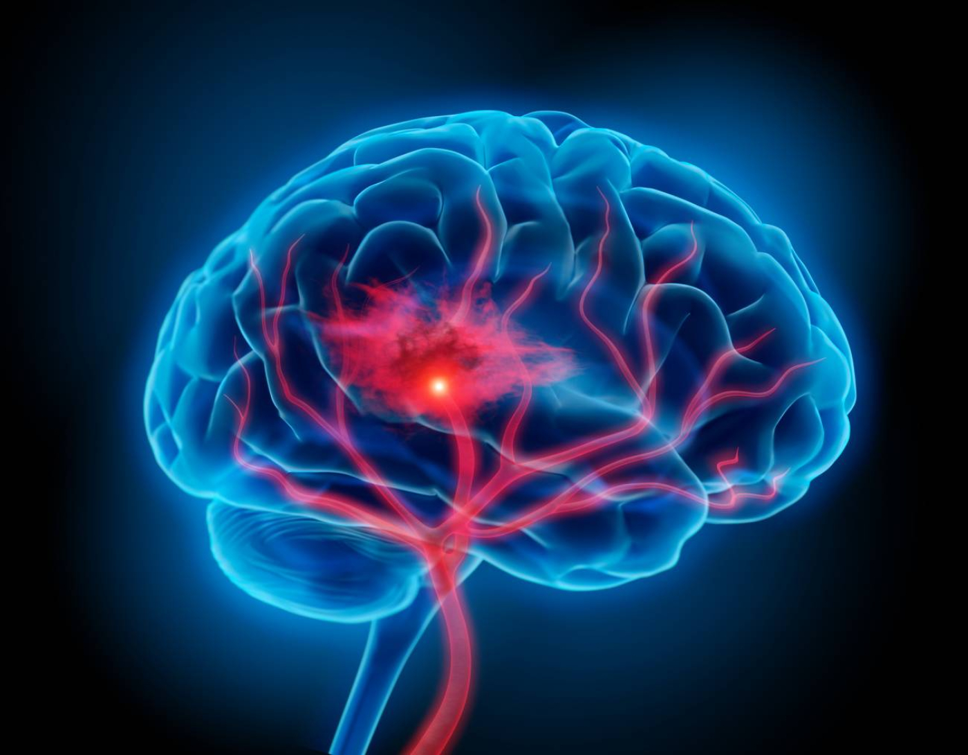 Una técnica biomatemática monitoriza la evolución del daño en accidentes cerebrovasculares