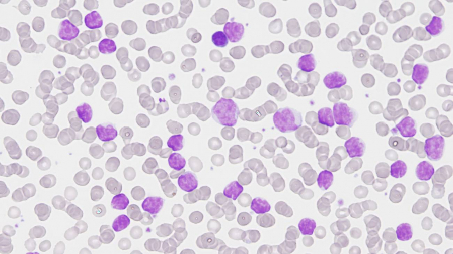 Completado el mapa genómico de la leucemia linfática crónica